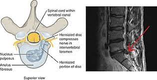 Slipped disc, which is a serious cause of concern. Sciatica Wikipedia