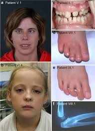 BCOR analysis in patients with OFCD and Lenz microphthalmia syndromes,  mental retardation with ocular anomalies, and cardiac laterality defects