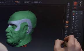 Shirley Anderson Gets a 3D Printed Jaw