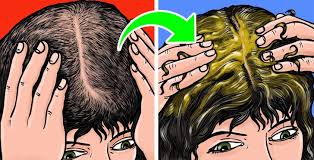 The medical condition telogen effluvium can develop as a consequence of severe mental stress, such as the loss of a loved one. 9 Ways To Regrow Your Hair Naturally And Forget About Bald Spots