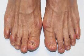 Image result for Onychotillomania feet