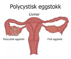 Cyst av corpus luteum av riktig eggstokk: Polycystisk Ovariesyndrom Laer Alt Om Det Her Utforsk Sinnet