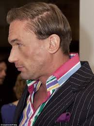 Dr christian debunks cancer myths stand up to cancer. Dr Christian Jessen Hair Transplant Before After How Much