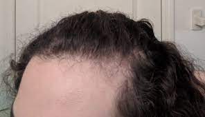 I M Only 17 But I Think I Have Receding Hairline Is There A Way To Fix This My Hair Is Naturally Curly And In Good Co Naturally Curly Best Hairline Hairline