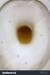 Liver Disease Dark Urine