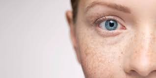 I've wanted to try this lemon thing for a while but im afraid it will make my whole face lighter not just the freckles. 5 Effective Treatment Options For Freckles