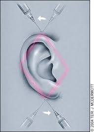 Image result for Ear Nerve Block