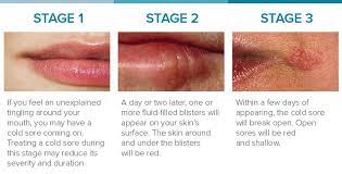 8 Ways To Treat Cold Sores In The Early Stages