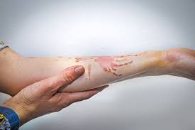 Oct 24, 2017 · in most cases, a simple examination is enough to identify a blood blister and diagnose any potential local infection. Does This Look Bad 5 Signs Of Infected Burn Oxford Urgent Care