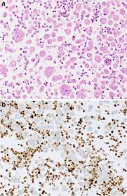 Mesothelioma, lung cancer, bap1, differential diagnosis,. Pleural Mesothelioma Classification Update Springerlink