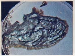 Image result for acholic stools human