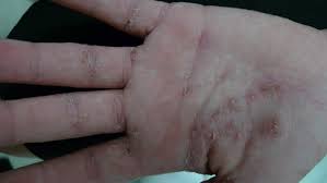 Image result for scabies human bites