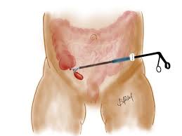 Image result for Appendicitis