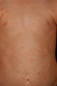 The link between essential mixed cryoglobulinemias and the c virus infection has been clearly evidenced., whereas its frequency seems low in other. Paravirale Exantheme Springerlink