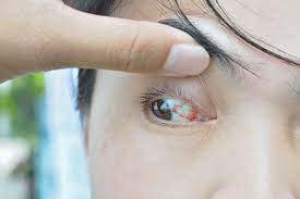 Soothe Conjunctivitis