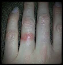 Ring Cleaning Avoid Ring Finger Rash Wedding Ring Rash Cleaning House Cleaning Tips