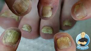 Bioclear Nail Fungus Pen Reviews Best Treatment For Your Toenail Fungus Foot Health Month 2018 20 Youtube