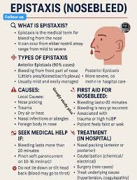 Image result for Epistaxis