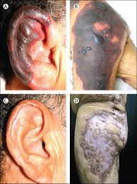 Purpura fulminans (pf) is a haematological emergency in which there is skin necrosis and disseminated intravascular coagulation. Purpura Fulminans 10 Years After Contaminated Cocaine Use The Lancet