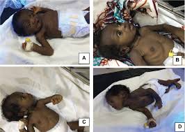 Image result for Kernicterus