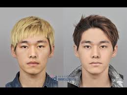 A hernia occurs when there is weakness or even a whole in a muscle that allows tissue or organs to bulge up through the defect. Guys Transform Into A Handsome Man Plastic Surgery Korea Before And After Youtube