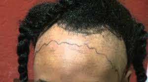 The difference is that this ponytail should not be tight. Black Women Receding Hairline Transplantation Los Gatos Near San Jose Dr Diep Www Mhtaclinic Com Youtube