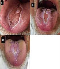 Image result for Fissured tongue