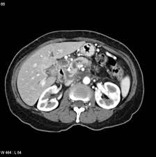 A ct scan of the tummy (abdomen) can show whether there any changes in the pancreas or nearby structures, such as the liver. Pancreatic Neoplasms Radiology Reference Article Radiopaedia Org