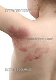 Image result for shingles in children