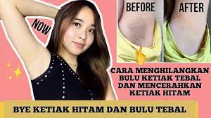 Cara menghilangkan ketiak hitam dan berbulu. Cara Ampuh Memutihkan Ketiak Hitam Menghilangkan Bulu Ketiak Permanen Youtube