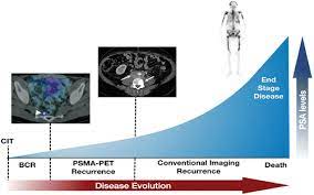 What are prostate cancer symptoms? Revisiting Prostate Cancer Recurrence With Psma Pet Atlas Of Typical And Atypical Patterns Of Spread Radiographics
