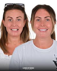 Dental Implant Treatment in Turkey with Lando's Smile