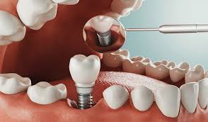 We did not find results for: What Is The Best Alternative For Teeth Implants Voss Dental Oral Surgery Implant