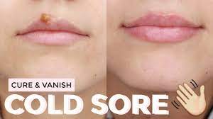 How To Cure A Cold Sore Fast Healed Scab Free Youtube