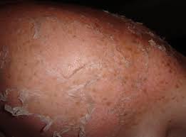 Over a lifetime, repeated episodes of sunburn and unprotected sun exposure can increase a person's risk of malignant melanoma and other forms of skin cancer. 5 Sunburns Increase Your Odds Of Skin Cancer Attn
