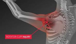 Image result for Rotator cuff tear