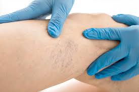 Membrelor boala varicoasă în orașul barnaul cât de mult o intervenție chirurgicală clinica moderna specializata in tratamentul varicelor. Tratament Varice Flebologie Pret Si Oferta Bucuresti