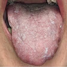 Image result for lichen planus on tongue)