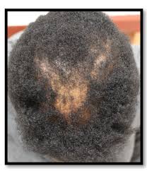 Dr. Donovan's Hair Loss Articles (2011-2024) — Donovan Hair Clinic