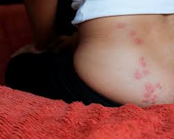 Image result for Cimex lectularius bites