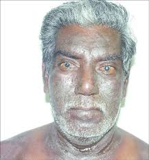 Image result for Photodermatitis