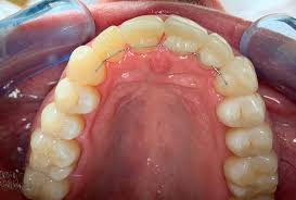 «rm8500 and 1.5 years later, the treatment is done. Modern Clear Zahnkorrektur Clear Aligner Treatments Das Fortschrittlichste System Fur Zahnkorrektur