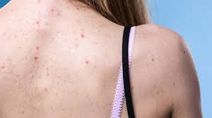 How long does it take for a sebaceous cyst to heal after surgery? Back Acne Bacne 101 Types Prevention And Treatment Everyday Health