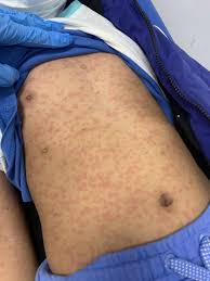 Image result for Generalized Rash