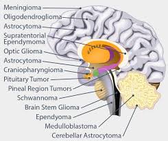 So if your brain is affected by cancer or its treatment, it's likely that you will experience some changes in personality. Brain Tumor Types Glioblastoma Meningioma More