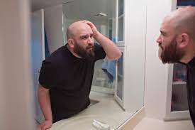 Metformin And Hair Loss Research Risks And Remedies