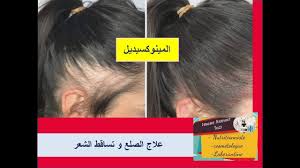 أقوى علاج لإنبات الشعر وتساقط الشعر Fda Approved المينوكسيديل جميع المعلومات قبل بدء العلاج Youtube