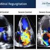 Mitral regurgitation is associated with cardiac malformation and can occur at any age, both in adults and in children. 1