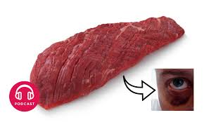 Pourquoi Mettre Un Steak Sur Un œil Au Beurre Noir