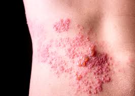 What causes shingles in young adults. Myhealth1st What Is Shingles And Am I At Risk Of Getting It